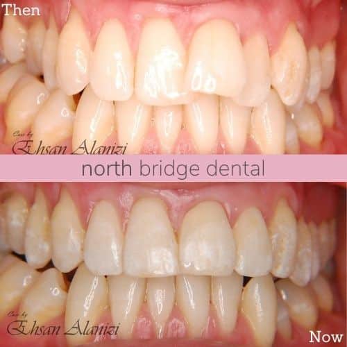 North Bridge Dental Practice Straight Teeth at North Bridge Hawick Before and after treatment at North Bridge Dental in Hawick
