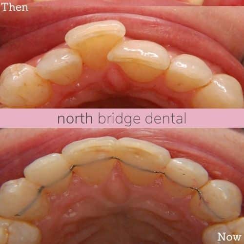 North Bridge Dental Practice Straight Teeth at North Bridge Hawick Before and after treatment at North Bridge Dental in Hawick