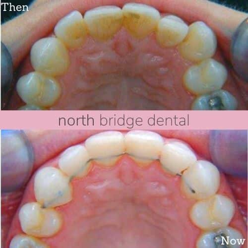 North Bridge Dental Practice Straight Teeth at North Bridge Hawick Before and after treatment at North Bridge Dental in Hawick
