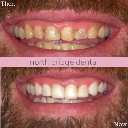 Before and after treatment at North Bridge Dental