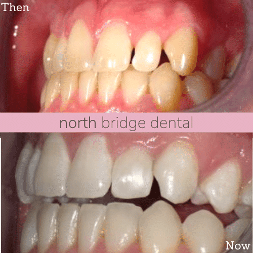 North Bridge Dental Practice Smile Gallery Before and after treatment at North Bridge Dental in Hawick