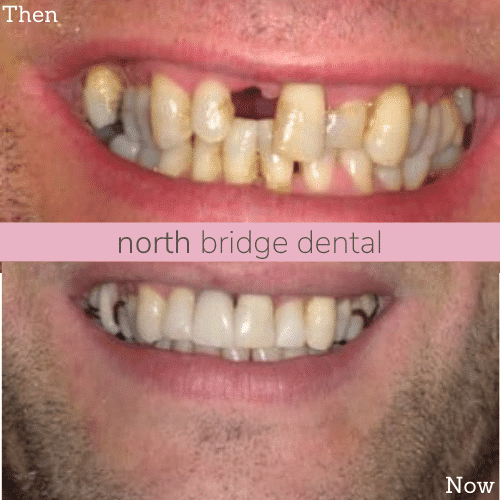 North Bridge Dental Practice Smile Gallery Before and after treatment at North Bridge Dental in Hawick