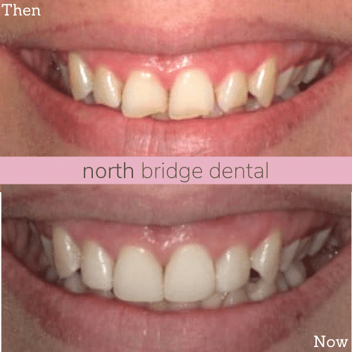 Before and after treatment at North Bridge Dental