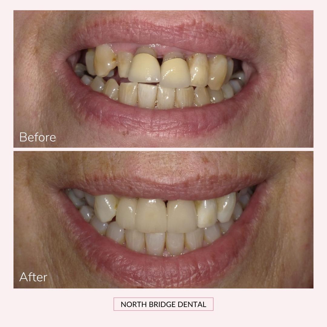 North Bridge Dental Practice Smile Gallery North Bridge Dental Practice Smile Gallery