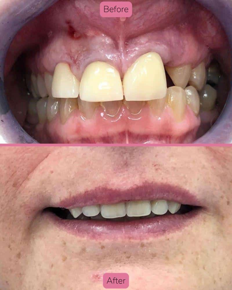 North Bridge Dental Practice Dr Faye Deane Before & after treatment with Faye
