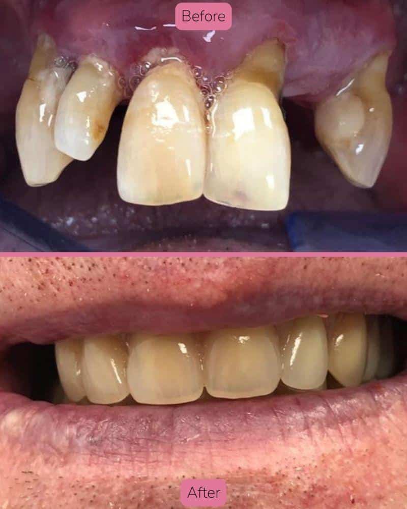 North Bridge Dental Practice Dr Faye Deane Before & after treatment with Faye