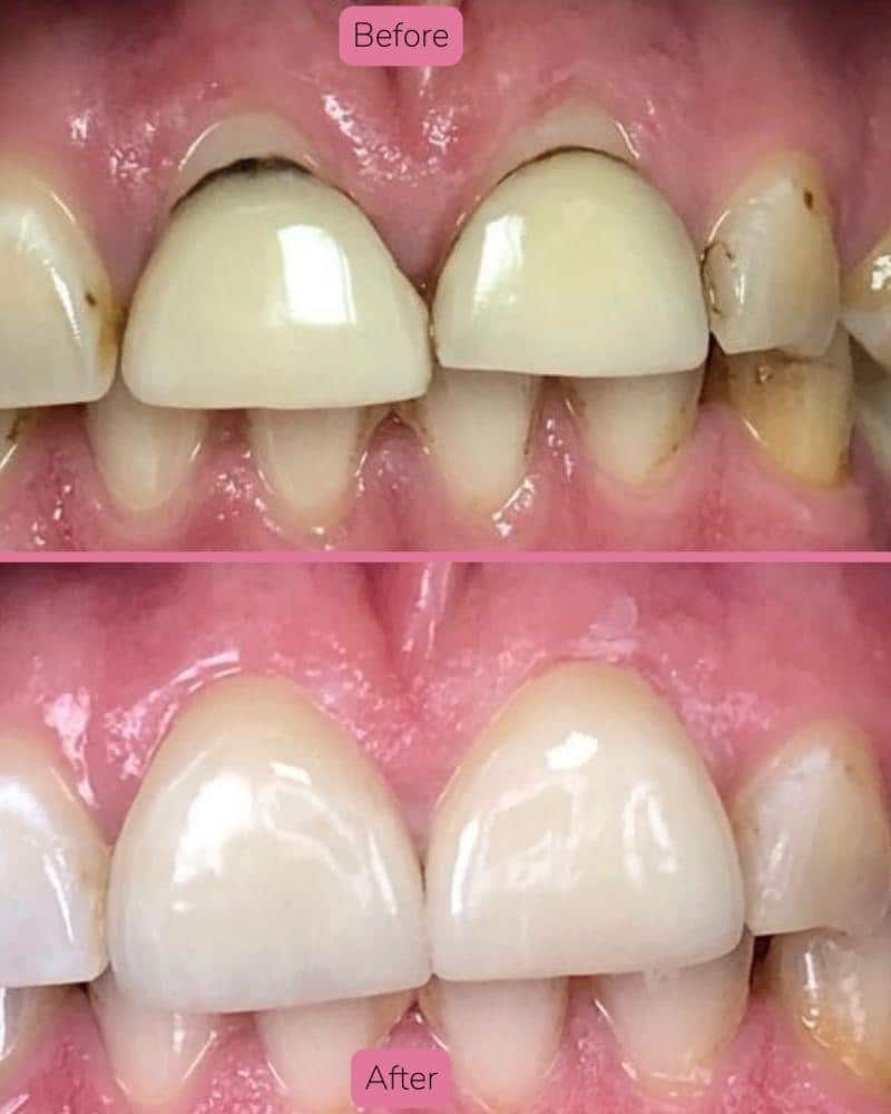 North Bridge Dental Practice Dr Faye Deane Before & after treatment with Faye
