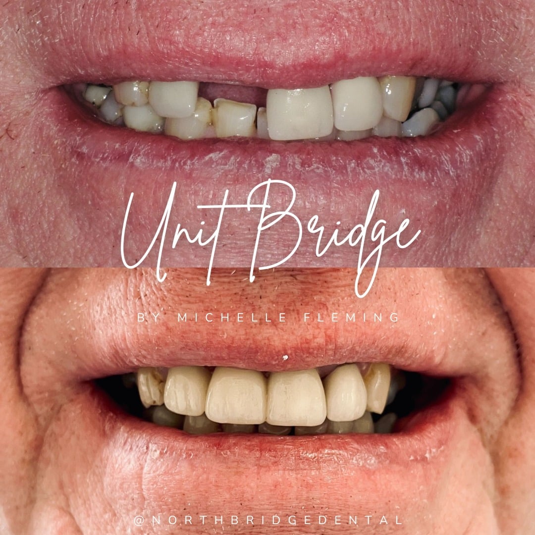 North Bridge Dental Practice Private Dental Practice in Hawick Before and after treatment at North Bridge Dental in Hawick