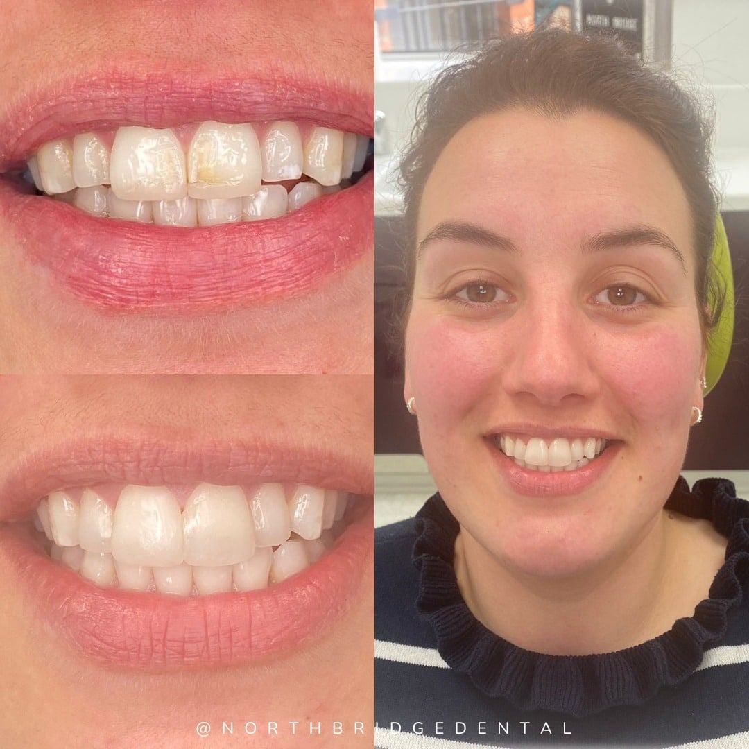 Teeth Whitening in Hawick